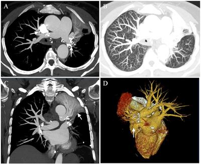 Bronchial artery embolization combined with left pulmonary resection in the treatment of fibrosing mediastinitis complicated with massive hemoptysis: a case report